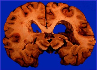 Alzheimer's cross-section