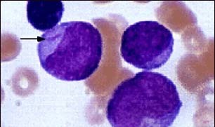 Acute myelocytic leukemia