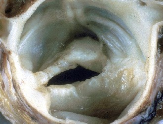 Bicuspid aortic valve