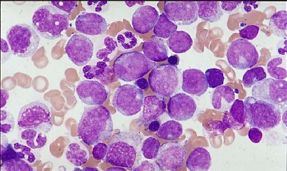 Chronic myeloid leukemia