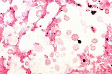 Cryptococcus neoformans