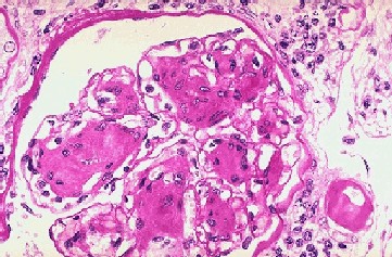 Nodular glomerulosclerosis (Diabetes)