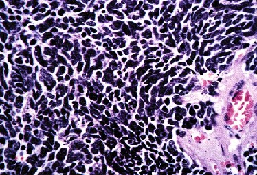 Oat cell carcinoma