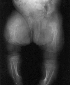 Osteogenesis imperfecta x-ray