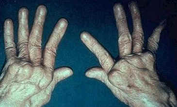 Rheumatoid arthritis