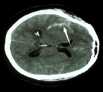 Subarachnoid hemorrhage