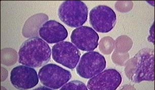 Acute lymphocytic leukemia