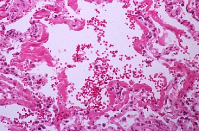 (ARDS) tissue