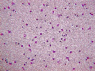 Chronic lymphocytic leukemia