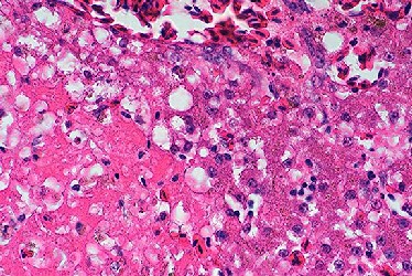 Coagulative necrosis