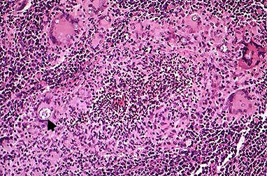 Coccidioides immitis