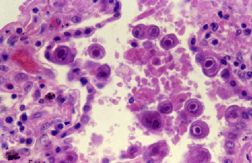 Cytomegalovirus