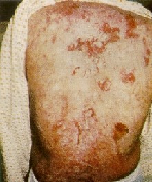 Lupus erythematosus