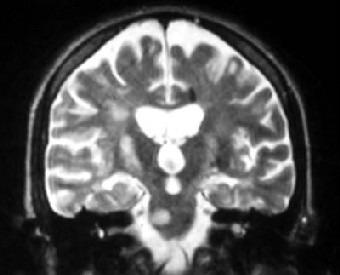 MS (Multiple sclerosis)