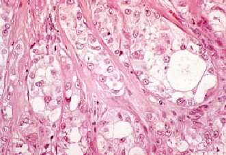 Renal cell carcinoma