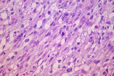 Squamous cell carcinoma
