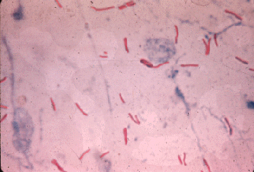 Tuberculosis
