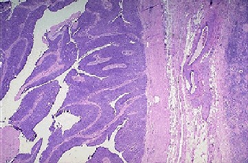 Transitional cell carcinoma